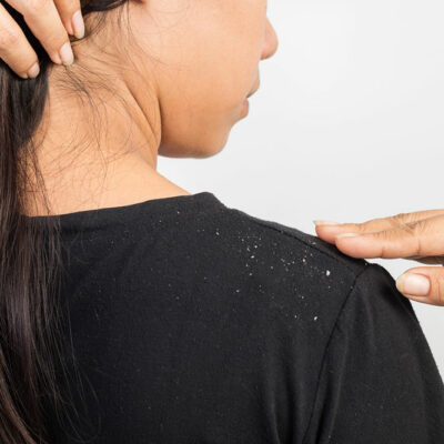 5 Natural Ways to Get Rid of Dandruff