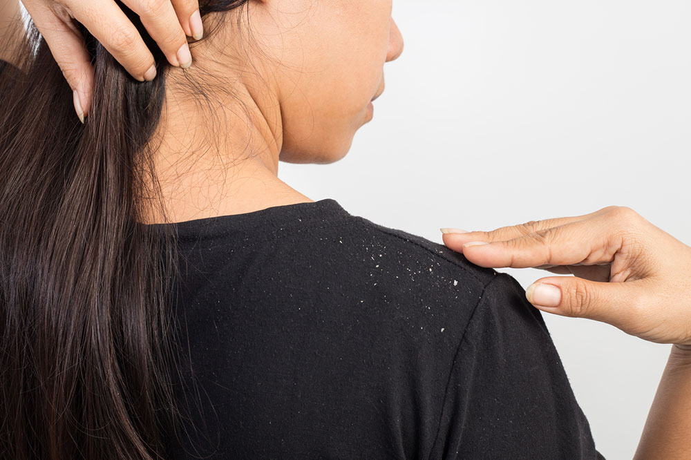 5 Natural Ways to Get Rid of Dandruff