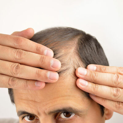 8 Natural Remedies for Hair Loss