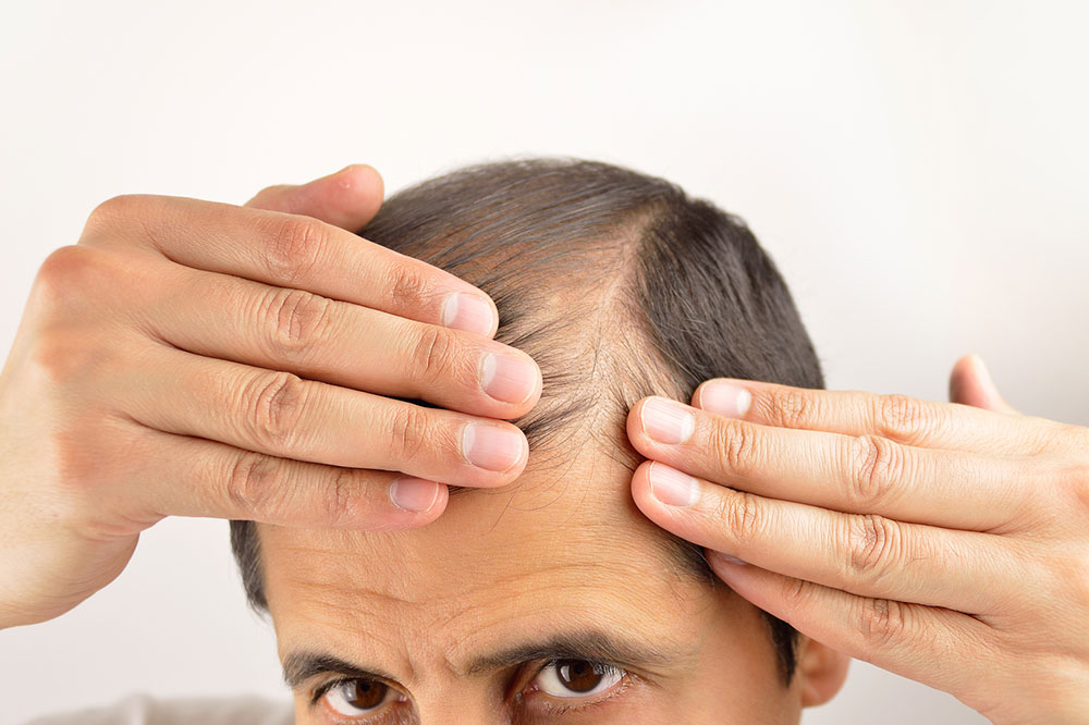 8 Natural Remedies for Hair Loss